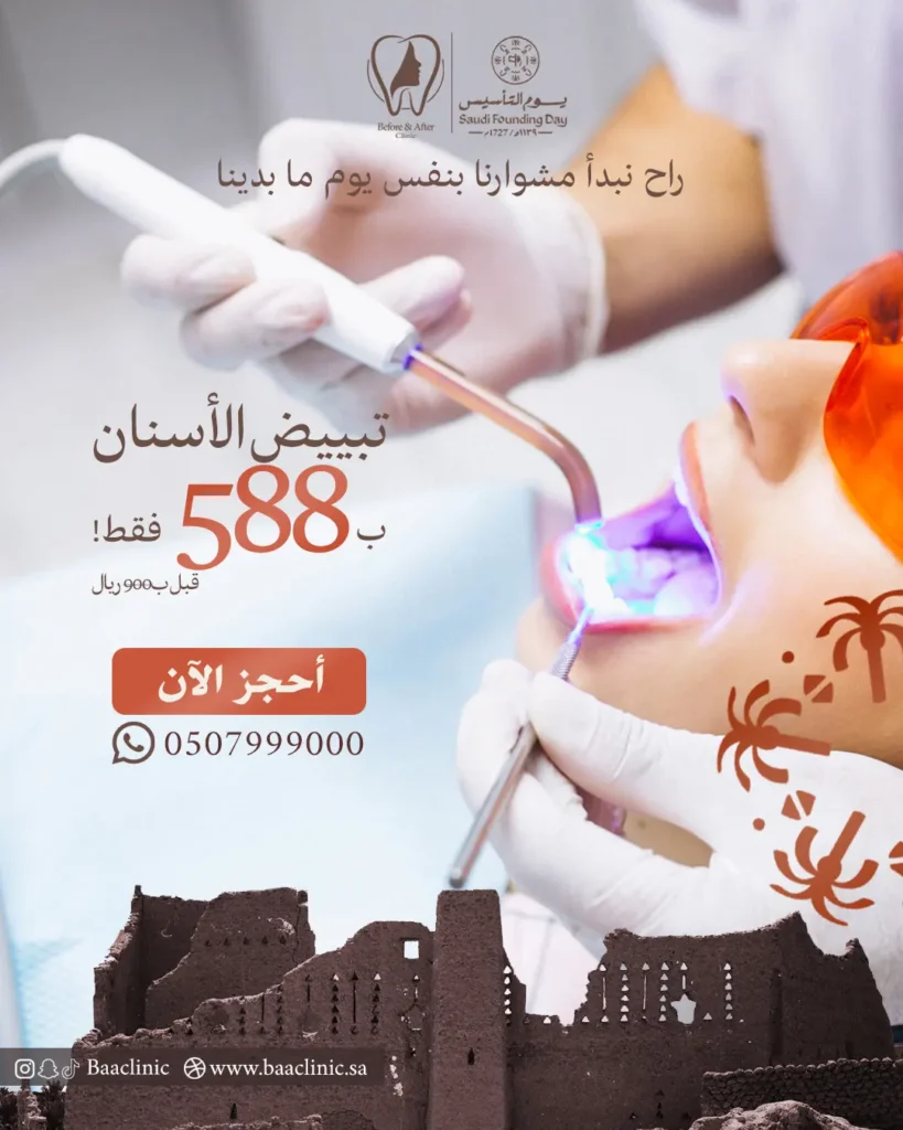 تبييض الأسنان بـ 588 ريال فقط!